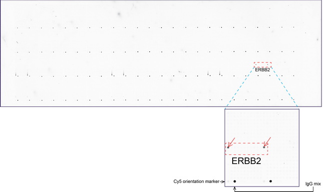 ERBB2 / HER2 Antibody - OriGene overexpression protein microarray chip was immunostained with UltraMAB anti-ERBB2 mouse monoclonal antibody. (Clone UMAB35). The positive reactive proteins are highlighted with two red arrows in the enlarged subarray. All the positive controls spotted in this subarray are also labeled for clarification. These data show that UltraMAB anti-ERBB2. (Clone UMAB35) very specifically recognizes ERBB2 antigen on OriGene protein microarray chip.