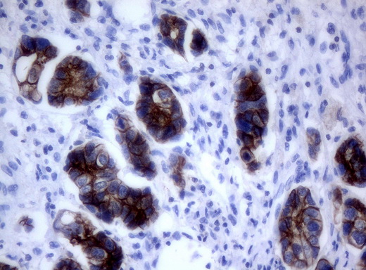 ERBB2 / HER2 Antibody - Immunohistochemical staining of paraffin-embedded Carcinoma of bladder tissue using anti-ERBB2mouse monoclonal antibody. (Clone UMAB35, dilution 1:100; heat-induced epitope retrieval by 10mM citric buffer, pH6.0, 120C for 3min)