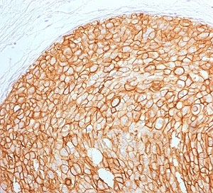 ERBB2 / HER2 Antibody - IHC testing of FFPE human breast carcinoma with ErbB2 antibody (clone 2KRI7-2). HIER: boil tissue sections in pH6, 10mM citrate buffer, for 10-20 min followed by cooling at RT for 20 min.