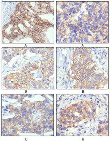 ERBB2 / HER2 Antibody - IHC of paraffin-embedded human breast intraductal carcinoma tissue(A) and breast infiltrating ductal carcinoma tissue(B) showing membrane localization using HER-2 mouse monoclonal antibody with DAB staining.