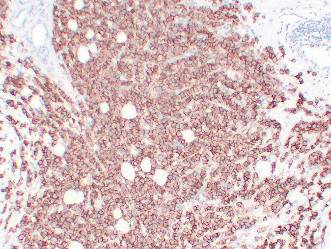 ERBB2 / HER2 Antibody - Breast Carcinoma 1