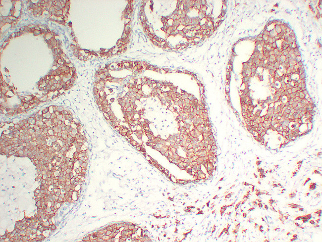 ERBB2 / HER2 Antibody - Breast Carcinoma 10