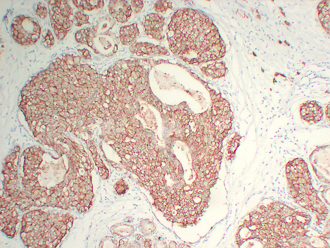 ERBB2 / HER2 Antibody - Breast Carcinoma 11