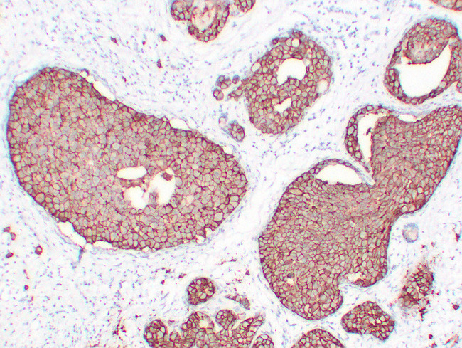 ERBB2 / HER2 Antibody - Breast Carcinoma 2