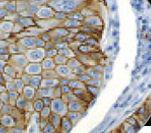 ERBB2 / HER2 Antibody - IHC of HER-2 neu on FFPE Breast Carcinoma tissue.