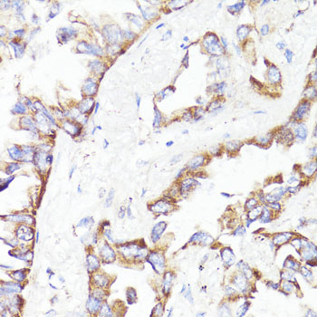 ERBB2 / HER2 Antibody - Immunohistochemistry of paraffin-embedded human lung cancer using ErbB2 antibody at dilution of 1:100 (40x lens).