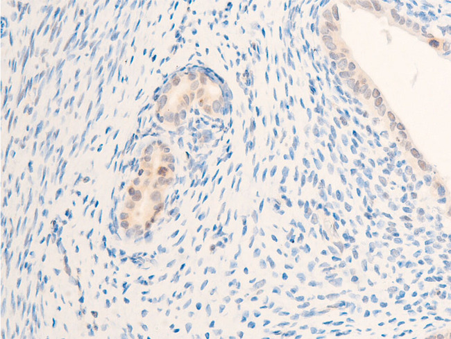 ERBB2 / HER2 Antibody - 1:100 staining rat uterine carcinoma tissue by IHC-P. The tissue was formaldehyde fixed and a heat mediated antigen retrieval step in citrate buffer was performed. The tissue was then blocked and incubated with the antibody for 1.5 hours at 22°C. An HRP conjugated goat anti-rabbit antibody was used as the secondary.