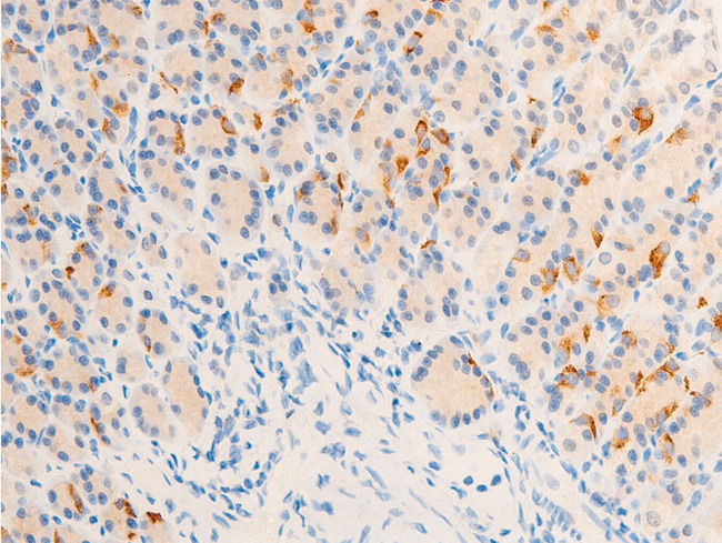 ERBB2 / HER2 Antibody - 1:100 staining rat gastric carcinoma tissue by IHC-P. The tissue was formaldehyde fixed and a heat mediated antigen retrieval step in citrate buffer was performed. The tissue was then blocked and incubated with the antibody for 1.5 hours at 22°C. An HRP conjugated goat anti-rabbit antibody was used as the secondary.