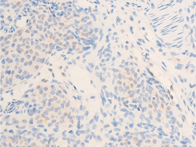 ERBB2 / HER2 Antibody - 1:100 staining rat ovarian carcinoma tissue by IHC-P. The tissue was formaldehyde fixed and a heat mediated antigen retrieval step in citrate buffer was performed. The tissue was then blocked and incubated with the antibody for 1.5 hours at 22°C. An HRP conjugated goat anti-rabbit antibody was used as the secondary.