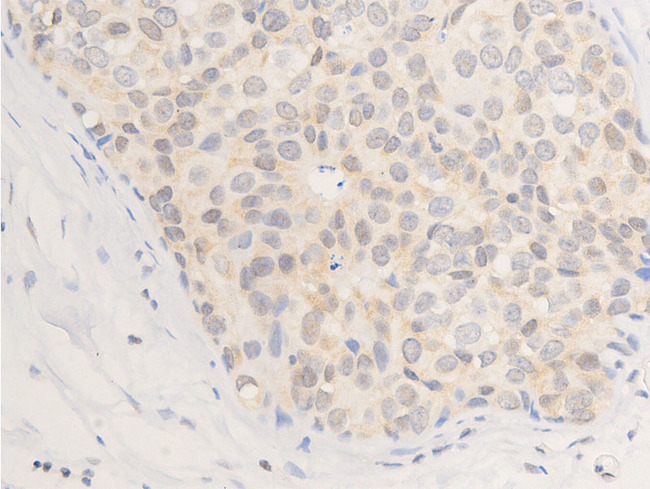 ERBB2 / HER2 Antibody - 1:100 staining human tongue carcinoma tissue by IHC-P. The tissue was formaldehyde fixed and a heat mediated antigen retrieval step in citrate buffer was performed. The tissue was then blocked and incubated with the antibody for 1.5 hours at 22°C. An HRP conjugated goat anti-rabbit antibody was used as the secondary.