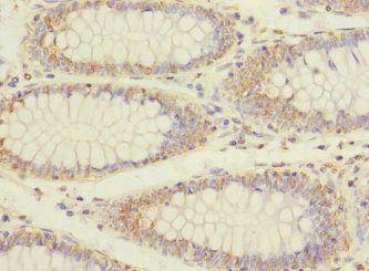 ERBB2IP / Erbin Antibody - Immunohistochemistry of paraffin-embedded human colon cancer at dilution 1:100