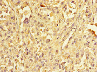 ERBB2IP / Erbin Antibody - Immunohistochemistry of paraffin-embedded human melanoma at dilution 1:100