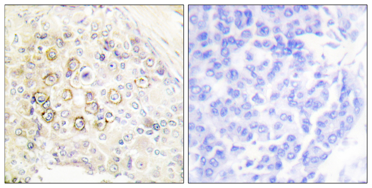 ERBB3 / HER3 Antibody - Immunohistochemistry analysis of paraffin-embedded human breast carcinoma tissue, using HER3 Antibody. The picture on the right is blocked with the synthesized peptide.