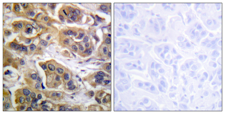 ERBB3 / HER3 Antibody - Immunohistochemistry analysis of paraffin-embedded human breast carcinoma tissue, using HER3 Antibody. The picture on the right is blocked with the synthesized peptide.