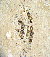 ERBB3 / HER3 Antibody - Formalin-fixed and paraffin-embedded human breast carcinoma with ErbB3 Antibody , which was peroxidase-conjugated to the secondary antibody, followed by DAB staining. This data demonstrates the use of this antibody for immunohistochemistry; clinical relevance has not been evaluated.
