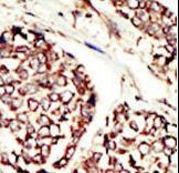 ERBB3 / HER3 Antibody - Formalin-fixed and paraffin-embedded human cancer tissue reacted with the primary antibody, which was peroxidase-conjugated to the secondary antibody, followed by DAB staining. This data demonstrates the use of this antibody for immunohistochemistry; clinical relevance has not been evaluated. BC = breast carcinoma; HC = hepatocarcinoma.