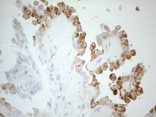 ERBB3 / HER3 Antibody - Immunohistochemical staining of paraffin-embedded Carcinoma of Human thyroid tissue using anti-ERBB3 mouse monoclonal antibody. (Heat-induced epitope retrieval by 1mM EDTA in 10mM Tris buffer. (pH8.5) at 120°C for 3 min. (1:150)
