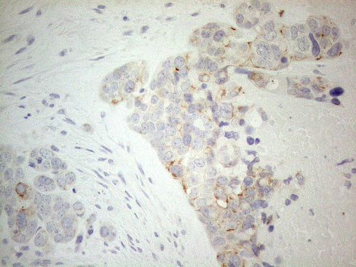 ERBB3 / HER3 Antibody - Immunohistochemical staining of paraffin-embedded Adenocarcinoma of Human endometrium tissue using anti-ERBB3 mouse monoclonal antibody. (Heat-induced epitope retrieval by 1mM EDTA in 10mM Tris buffer. (pH8.5) at 120°C for 3 min. (1:150)