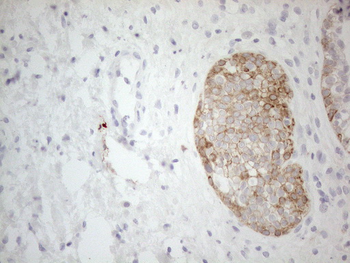 ERBB3 / HER3 Antibody - Immunohistochemical staining of paraffin-embedded Carcinoma of Human prostate tissue using anti-ERBB3 mouse monoclonal antibody. (Heat-induced epitope retrieval by 1mM EDTA in 10mM Tris buffer. (pH8.5) at 120°C for 3 min. (1:150)
