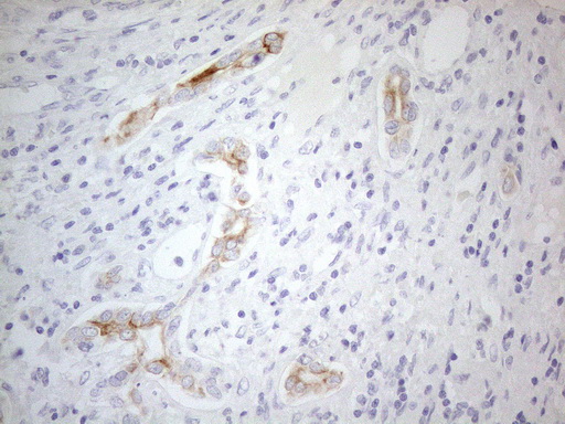 ERBB3 / HER3 Antibody - Immunohistochemical staining of paraffin-embedded Carcinoma of Human liver tissue using anti-ERBB3 mouse monoclonal antibody. (Heat-induced epitope retrieval by 1mM EDTA in 10mM Tris buffer. (pH8.5) at 120°C for 3 min. (1:150)