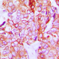 ERBB3 / HER3 Antibody - Immunohistochemical analysis of HER3 (pY1328) staining in human breast cancer formalin fixed paraffin embedded tissue section. The section was pre-treated using heat mediated antigen retrieval with sodium citrate buffer (pH 6.0). The section was then incubated with the antibody at room temperature and detected using an HRP conjugated compact polymer system. DAB was used as the chromogen. The section was then counterstained with hematoxylin and mounted with DPX.