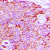 ERBB3 / HER3 Antibody - Immunohistochemical analysis of HER3 staining in human breast cancer formalin fixed paraffin embedded tissue section. The section was pre-treated using heat mediated antigen retrieval with sodium citrate buffer (pH 6.0). The section was then incubated with the antibody at room temperature and detected using an HRP polymer system. DAB was used as the chromogen. The section was then counterstained with hematoxylin and mounted with DPX.