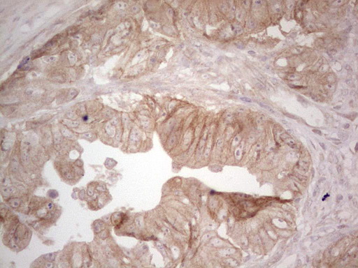 ERBB3 / HER3 Antibody - IHC of paraffin-embedded Adenocarcinoma of Human colon tissue using anti-ERBB3 mouse monoclonal antibody. (Heat-induced epitope retrieval by 1 mM EDTA in 10mM Tris, pH8.5, 120°C for 3min).