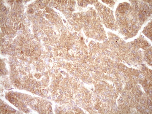 ERBB3 / HER3 Antibody - IHC of paraffin-embedded Carcinoma of Human liver tissue using anti-ERBB3 mouse monoclonal antibody. (Heat-induced epitope retrieval by 1 mM EDTA in 10mM Tris, pH8.5, 120°C for 3min).