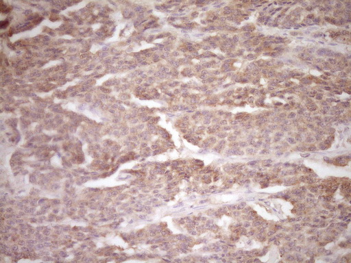 ERBB3 / HER3 Antibody - IHC of paraffin-embedded Carcinoma of Human lung tissue using anti-ERBB3 mouse monoclonal antibody. (Heat-induced epitope retrieval by 1 mM EDTA in 10mM Tris, pH8.5, 120°C for 3min).