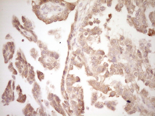 ERBB3 / HER3 Antibody - IHC of paraffin-embedded Adenocarcinoma of Human ovary tissue using anti-ERBB3 mouse monoclonal antibody. (Heat-induced epitope retrieval by 1 mM EDTA in 10mM Tris, pH8.5, 120°C for 3min).