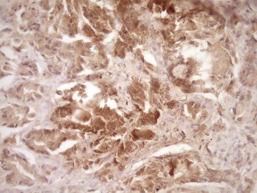 ERBB3 / HER3 Antibody - IHC of paraffin-embedded Carcinoma of Human prostate tissue using anti-ERBB3 mouse monoclonal antibody. (Heat-induced epitope retrieval by 1 mM EDTA in 10mM Tris, pH8.5, 120°C for 3min).