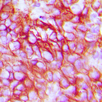 ERBB3 / HER3 Antibody - Immunohistochemical analysis of HER3 staining in human breast cancer formalin fixed paraffin embedded tissue section. The section was pre-treated using heat mediated antigen retrieval with sodium citrate buffer (pH 6.0). The section was then incubated with the antibody at room temperature and detected using an HRP conjugated compact polymer system. DAB was used as the chromogen. The section was then counterstained with hematoxylin and mounted with DPX.