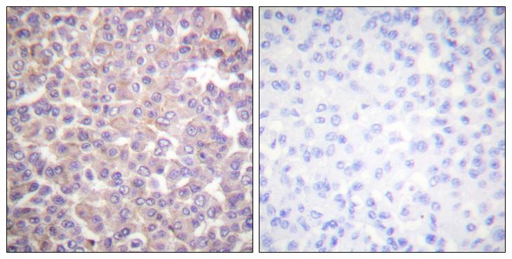 ERBB3 / HER3 Antibody - Peptide - + Immunohistochemistry analysis of paraffin-embedded human breast carcinoma tissue using HER3/ErbB3 (Ab-1289) antibody.