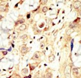 ERBB4 / HER4 Antibody - Formalin-fixed and paraffin-embedded human cancer tissue reacted with the primary antibody, which was peroxidase-conjugated to the secondary antibody, followed by DAB staining. This data demonstrates the use of this antibody for immunohistochemistry; clinical relevance has not been evaluated. BC = breast carcinoma; HC = hepatocarcinoma.