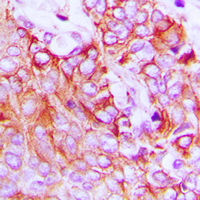 ERBB4 / HER4 Antibody - Immunohistochemical analysis of HER4 staining in human breast cancer formalin fixed paraffin embedded tissue section. The section was pre-treated using heat mediated antigen retrieval with sodium citrate buffer (pH 6.0). The section was then incubated with the antibody at room temperature and detected using an HRP conjugated compact polymer system. DAB was used as the chromogen. The section was then counterstained with hematoxylin and mounted with DPX.