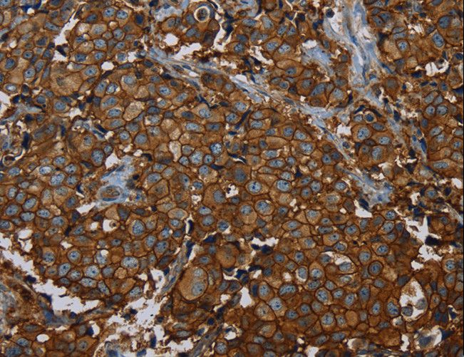 ERBB4 / HER4 Antibody - Immunohistochemistry of paraffin-embedded Human breast cancer using ERBB4 Polyclonal Antibody at dilution of 1:40.
