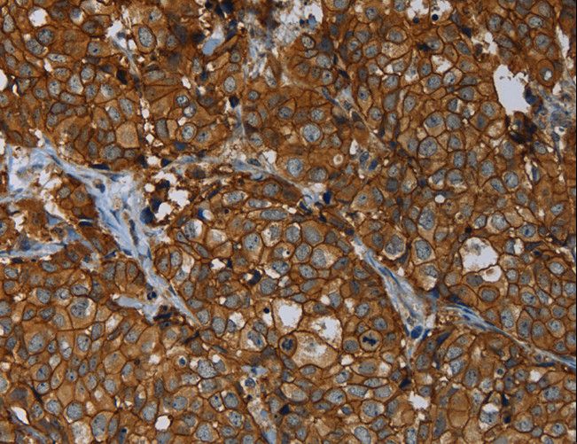ERBB4 / HER4 Antibody - Immunohistochemistry of paraffin-embedded Human liver cancer using ERBB4 Polyclonal Antibody at dilution of 1:40.