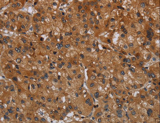 ERBB4 / HER4 Antibody - Immunohistochemistry of paraffin-embedded Human liver cancer using ERBB4 Polyclonal Antibody at dilution of 1:40.
