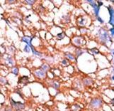 ERBB4 / HER4 Antibody - Formalin-fixed and paraffin-embedded human cancer tissue reacted with the primary antibody, which was peroxidase-conjugated to the secondary antibody, followed by AEC staining. This data demonstrates the use of this antibody for immunohistochemistry; clinical relevance has not been evaluated. BC = breast carcinoma; HC = hepatocarcinoma.