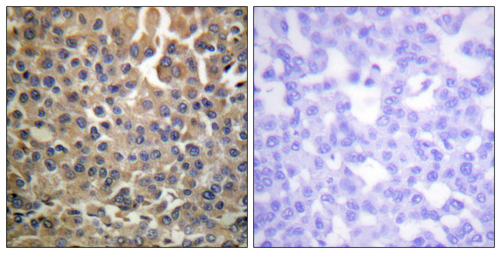 ERBB4 / HER4 Antibody - Immunohistochemistry analysis of paraffin-embedded human breast carcinoma, using HER4 (Phospho-Tyr1284) Antibody. The picture on the right is blocked with the phospho peptide.