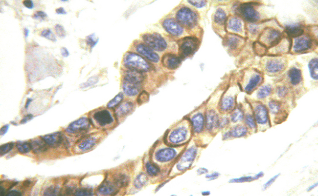 ERBB4 / HER4 Antibody - 1/100 staining human breast carcinoma tissue by IHC-P. The sample was formaldehyde fixed and a heat mediated antigen retrieval step in citrate buffer was performed. The sample was then blocked and incubated with the antibody for 1.5 hours at 22°C. An HRP conjugated goat anti-rabbit antibody was used as the secondary antibody.
