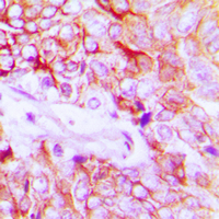 ERBB4 / HER4 Antibody - Immunohistochemical analysis of HER4 (pY1284) staining in human breast cancer formalin fixed paraffin embedded tissue section. The section was pre-treated using heat mediated antigen retrieval with sodium citrate buffer (pH 6.0). The section was then incubated with the antibody at room temperature and detected using an HRP conjugated compact polymer system. DAB was used as the chromogen. The section was then counterstained with hematoxylin and mounted with DPX.