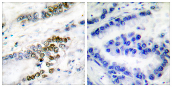ERCC1 Antibody - Immunohistochemistry analysis of paraffin-embedded human lung carcinoma tissue, using ERCC1 Antibody. The picture on the right is blocked with the synthesized peptide.