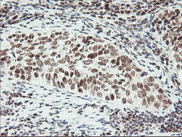 ERCC1 Antibody - Immunohistochemical staining of paraffin-embedded Carcinoma of Human lung tissue using anti-ERCC1 mouse monoclonal antibody. (Clone 2E12, dilution 1:100; heat-induced epitope retrieval by 10mM citric buffer, pH6.0, 120C for 3min)