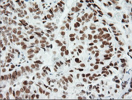ERCC1 Antibody - Immunohistochemical staining of paraffin-embedded Adenocarcinoma of Human ovary tissue using anti-ERCC1 mouse monoclonal antibody. (Clone 2E12, dilution 1:100; heat-induced epitope retrieval by 10mM citric buffer, pH6.0, 120C for 3min)