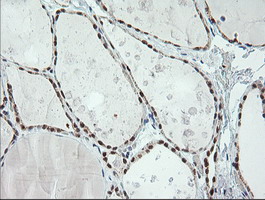 ERCC1 Antibody - Immunohistochemical staining of paraffin-embedded Human thyroid tissue using anti-ERCC1 mouse monoclonal antibody. (Clone 2E12, dilution 1:100; heat-induced epitope retrieval by 10mM citric buffer, pH6.0, 120C for 3min)