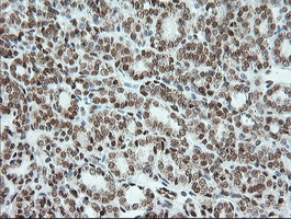 ERCC1 Antibody - Immunohistochemical staining of paraffin-embedded Carcinoma of Human thyroid tissue using anti-ERCC1 mouse monoclonal antibody. (Clone 2E12, dilution 1:100; heat-induced epitope retrieval by 10mM citric buffer, pH6.0, 120C for 3min)