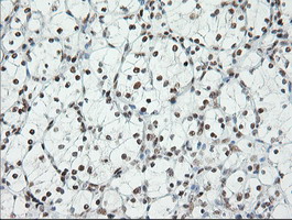 ERCC1 Antibody - Immunohistochemical staining of paraffin-embedded Carcinoma of Human kidney tissue using anti-ERCC1 mouse monoclonal antibody. (Clone 2E12, dilution 1:100; heat-induced epitope retrieval by 10mM citric buffer, pH6.0, 120C for 3min)