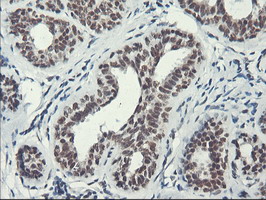 ERCC1 Antibody - Immunohistochemical staining of paraffin-embedded Human breast tissue using anti-ERCC1 mouse monoclonal antibody. (Clone 2E12, dilution 1:100; heat-induced epitope retrieval by 10mM citric buffer, pH6.0, 120C for 3min)