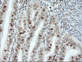 ERCC1 Antibody - Immunohistochemical staining of paraffin-embedded Adenocarcinoma of Human endometrium tissue using anti-ERCC1 mouse monoclonal antibody. (Clone 2E12, dilution 1:100; heat-induced epitope retrieval by 10mM citric buffer, pH6.0, 120C for 3min)